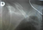 Broken collar bone